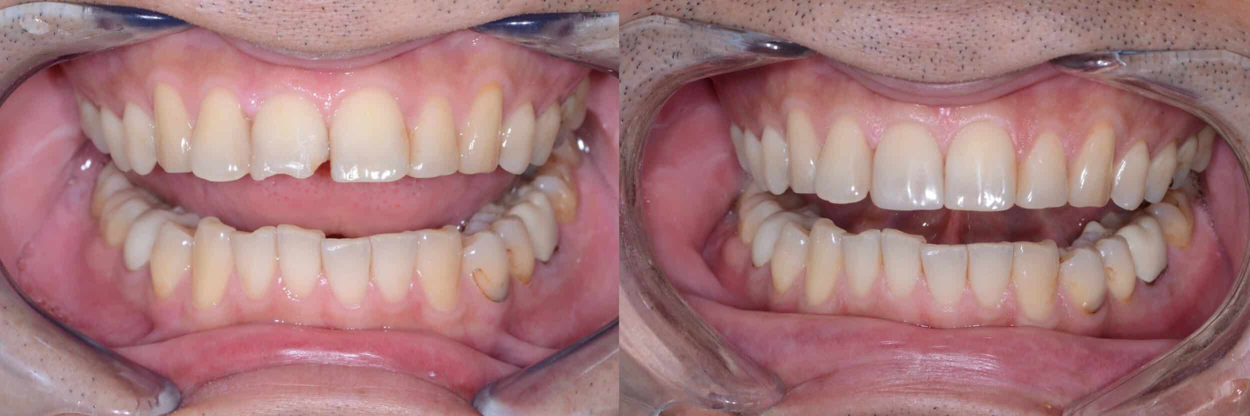 Before and After Image: Composite Bonding -