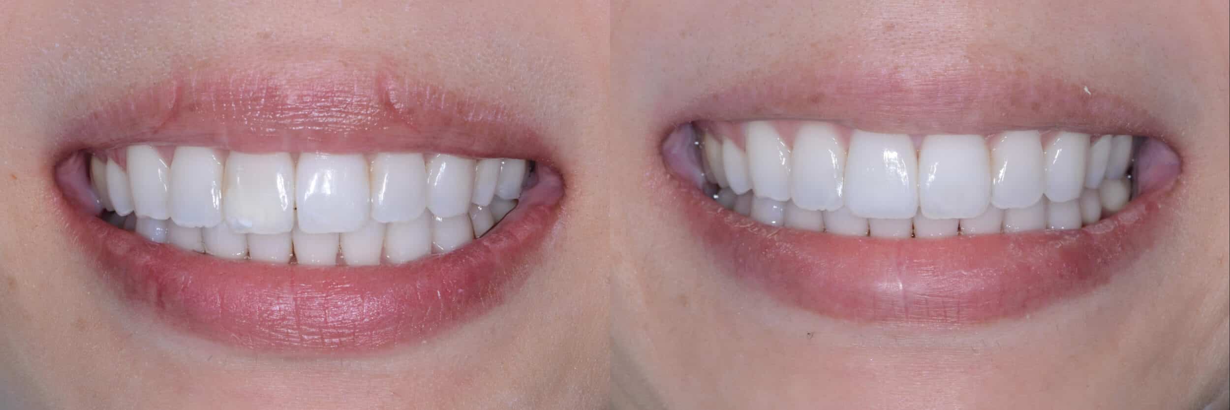 Before and After Image: Zirconia Crown - front