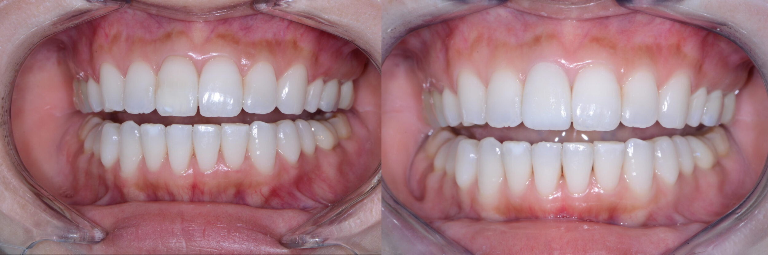 Before and After Image: Zirconia Crown - 