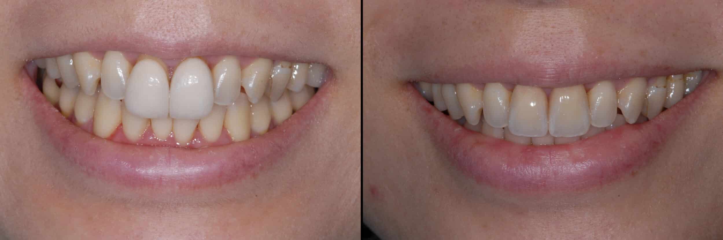 Before and After Image: Emax Veneers - front