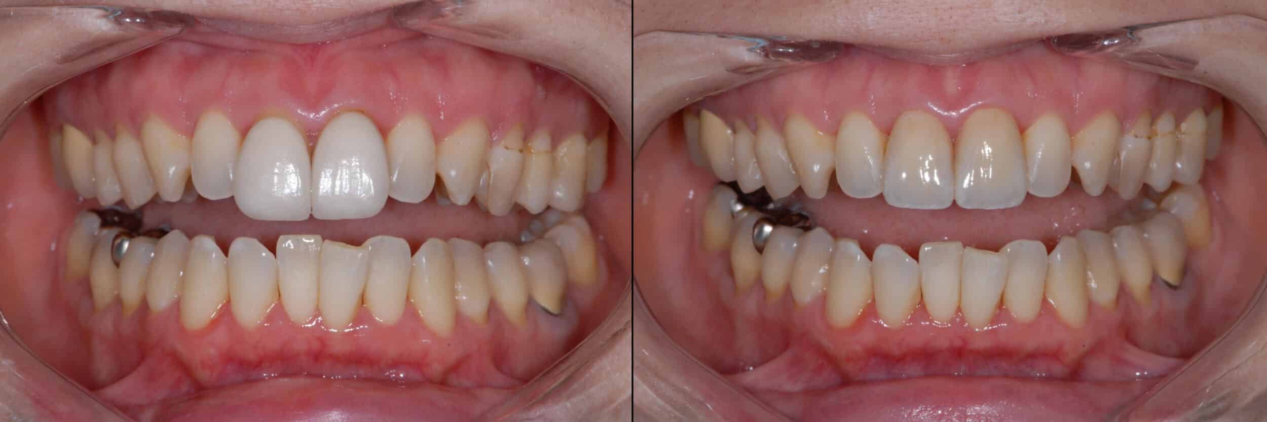 Before and After Image: Emax Veneers -