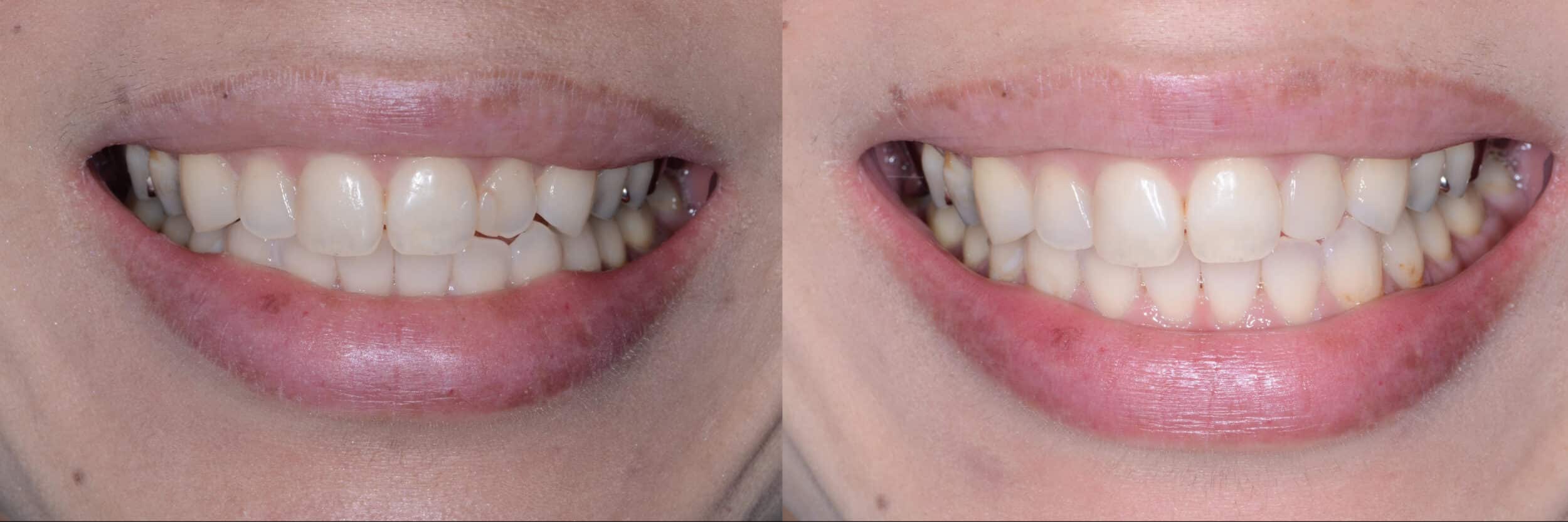 Before and After Image: Composite Bonding - front