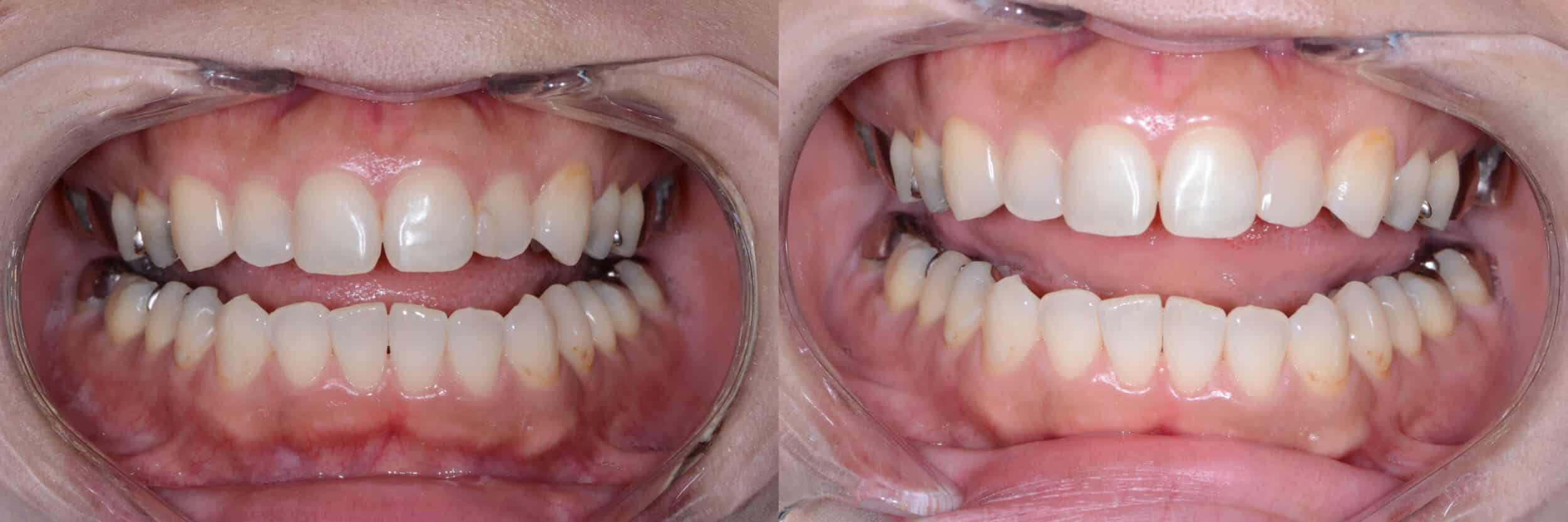 Before and After Image: Composite Bonding -