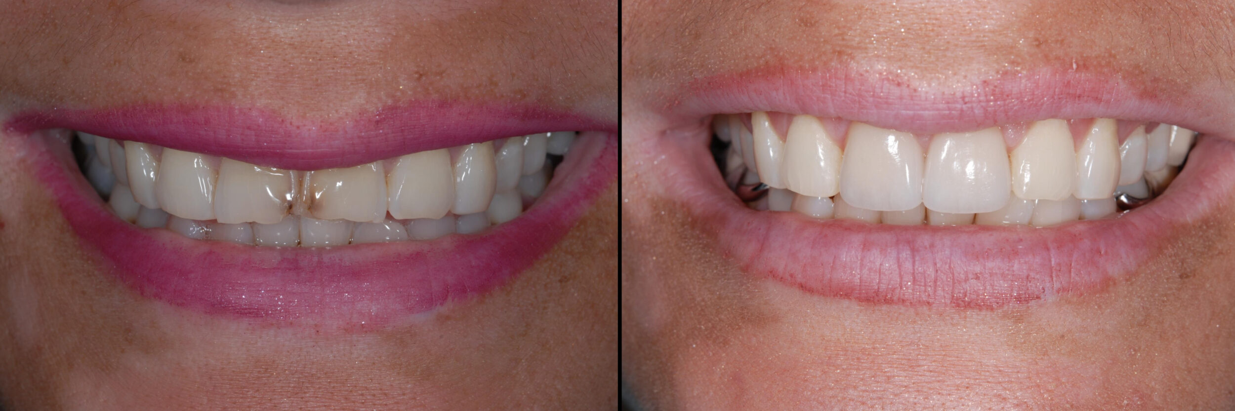 Before and After Image: Feldspathic Veneers - front