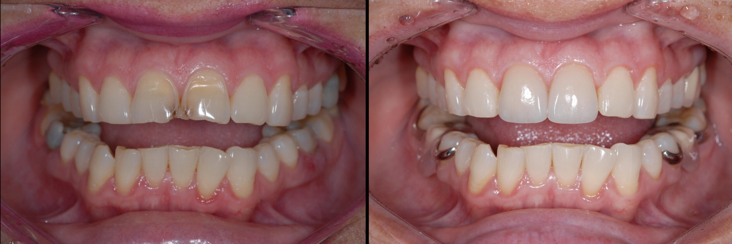 Before and After Image: Feldspathic Veneers - 