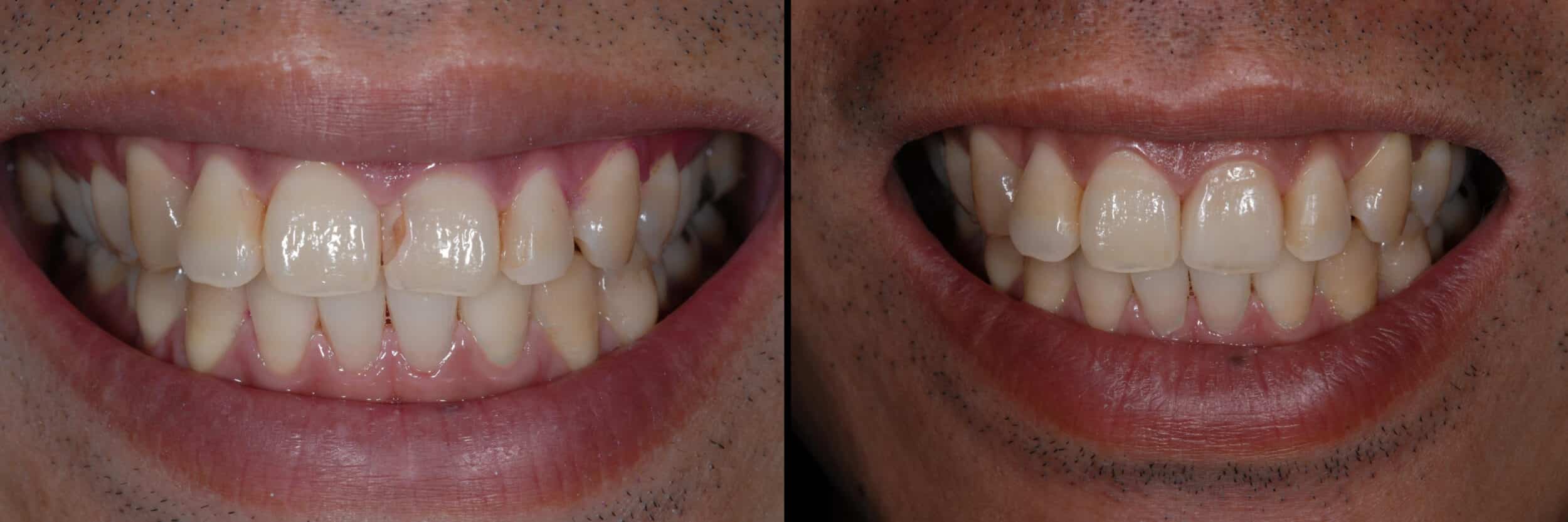 Before and After Image: Feldspathic Veneer - front