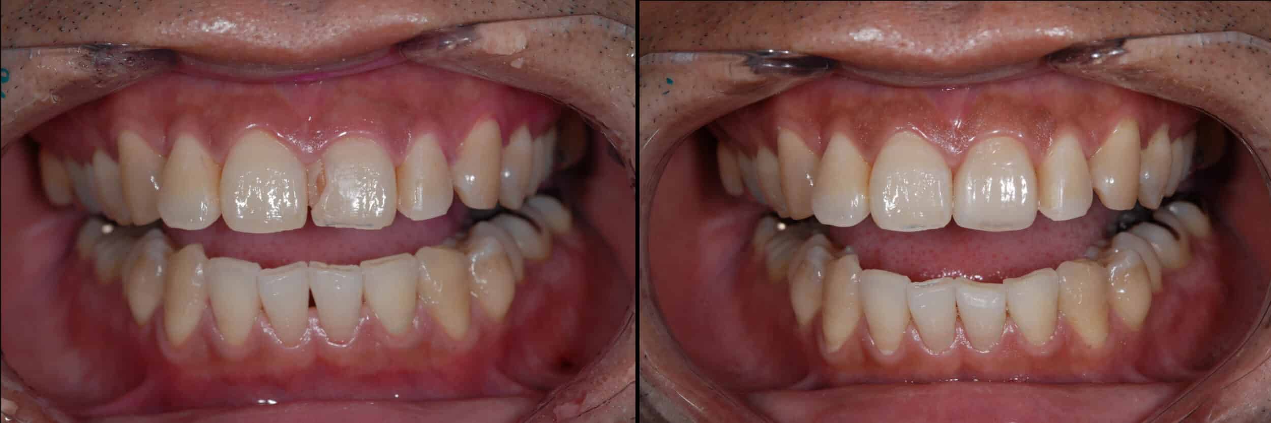 Before and After Image: Feldspathic Veneer -