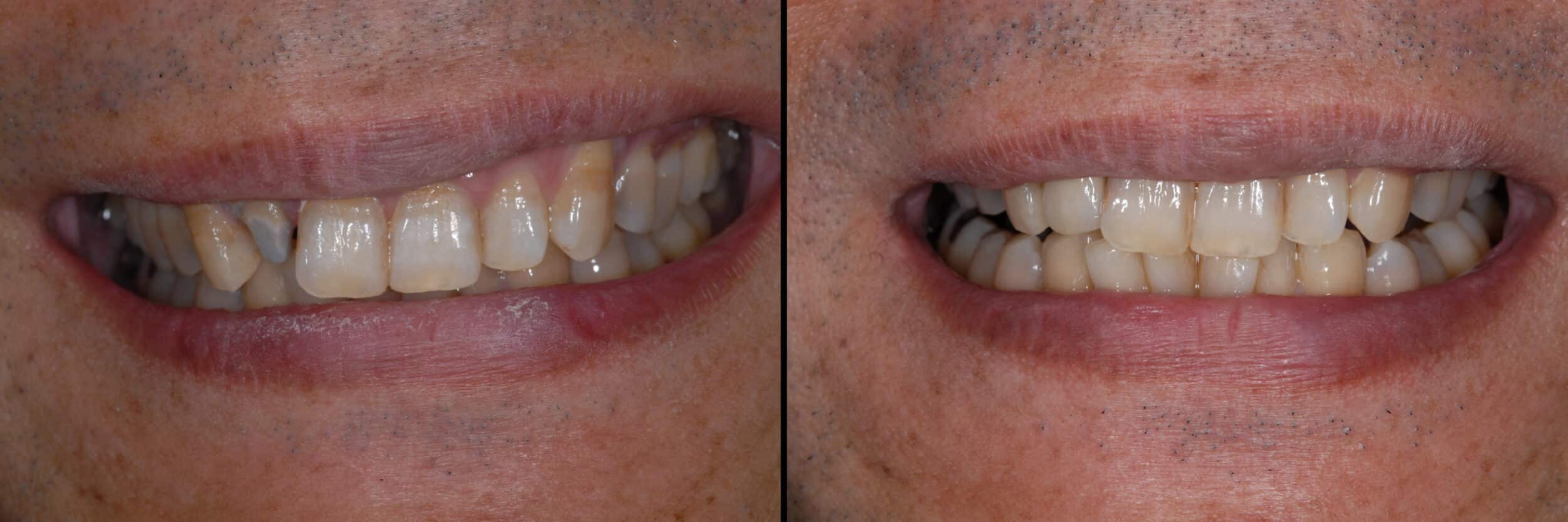 Before and After Image: Emax Crown - front