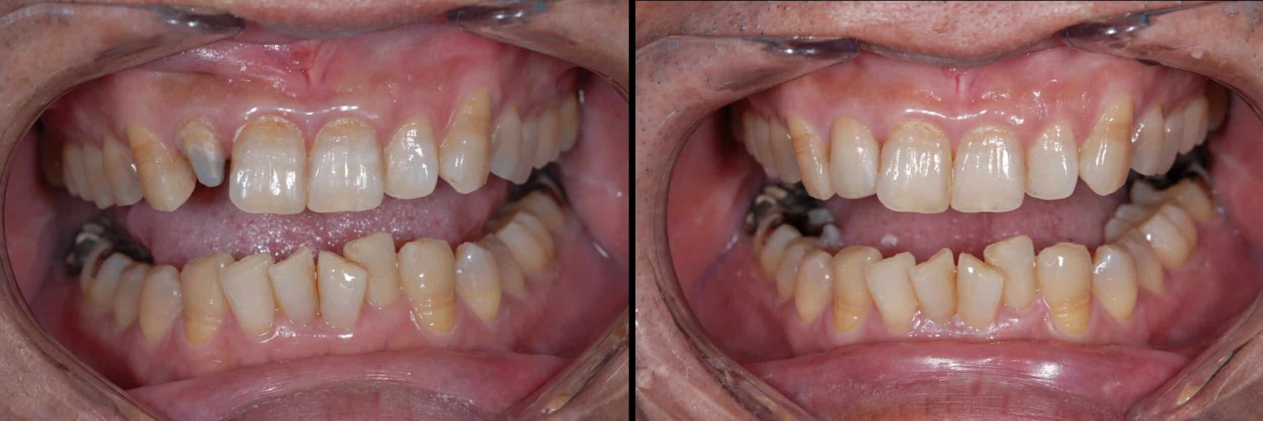 Before and After Image: Emax Crown -