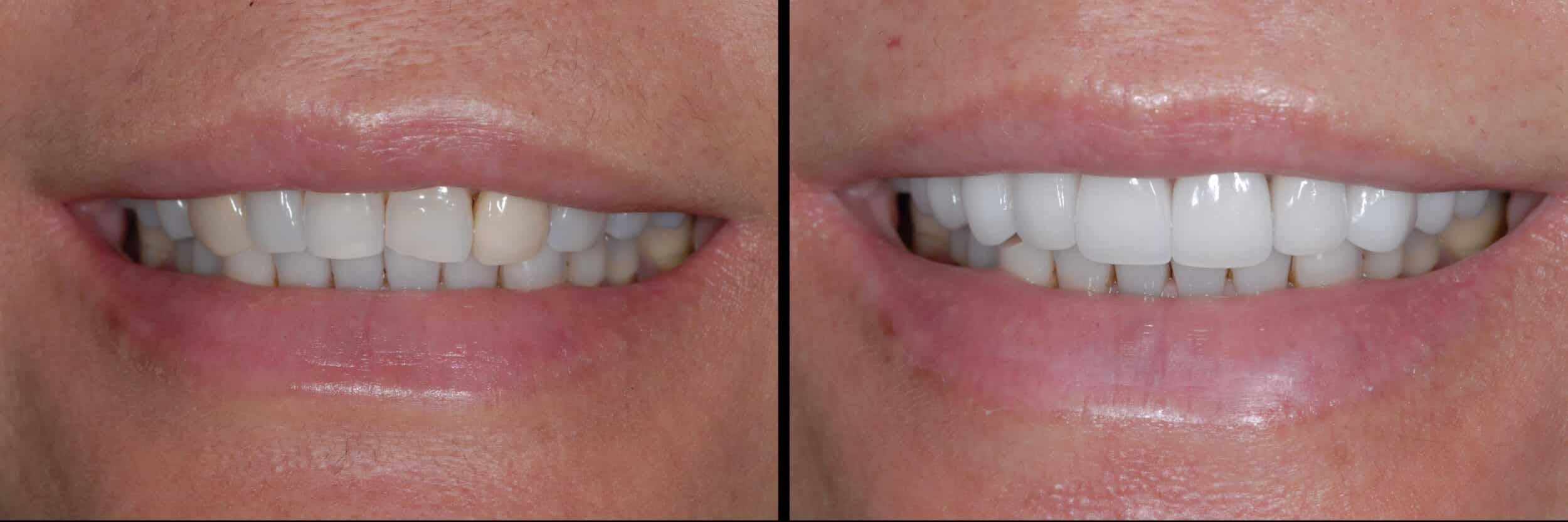 Before and After Image: Veneers - front