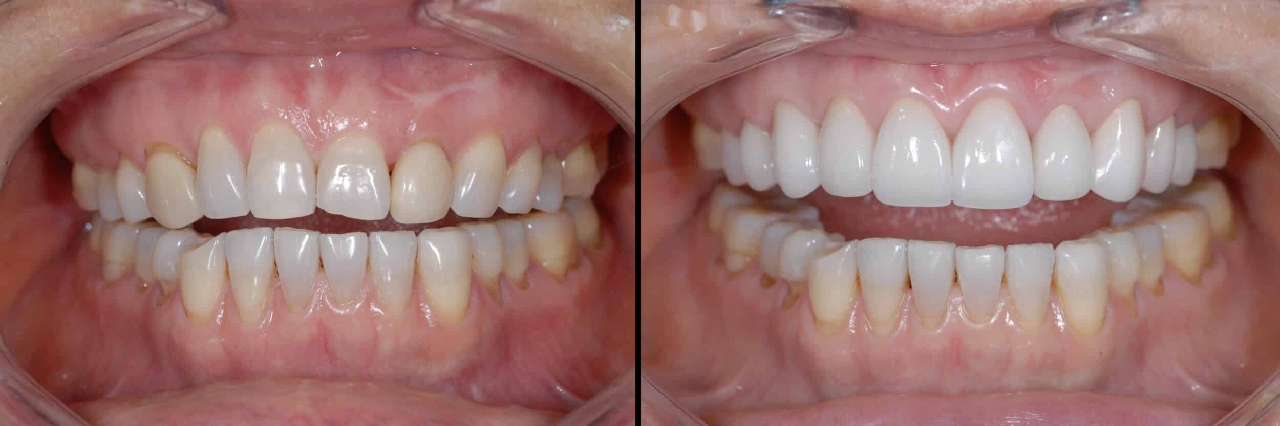 Before and After Image: Veneers - front