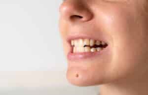 Close-up of woman with crooked, yellow teeth and malocclusion, illustrating adult orthodontic problems and need for dental treatment.