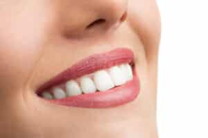 Close-up shot of a woman's smile after treating a dark line around a veneer