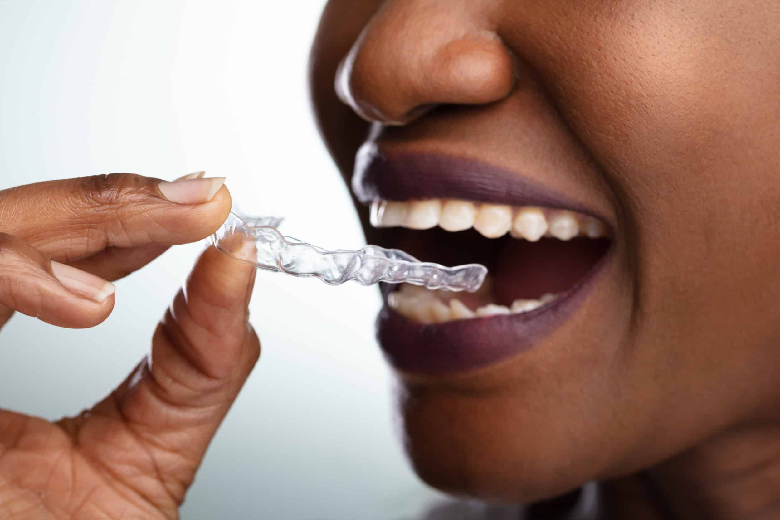 Close-up,Of,A,Woman's,Hand,Putting,Transparent,Aligner,In,Teeth